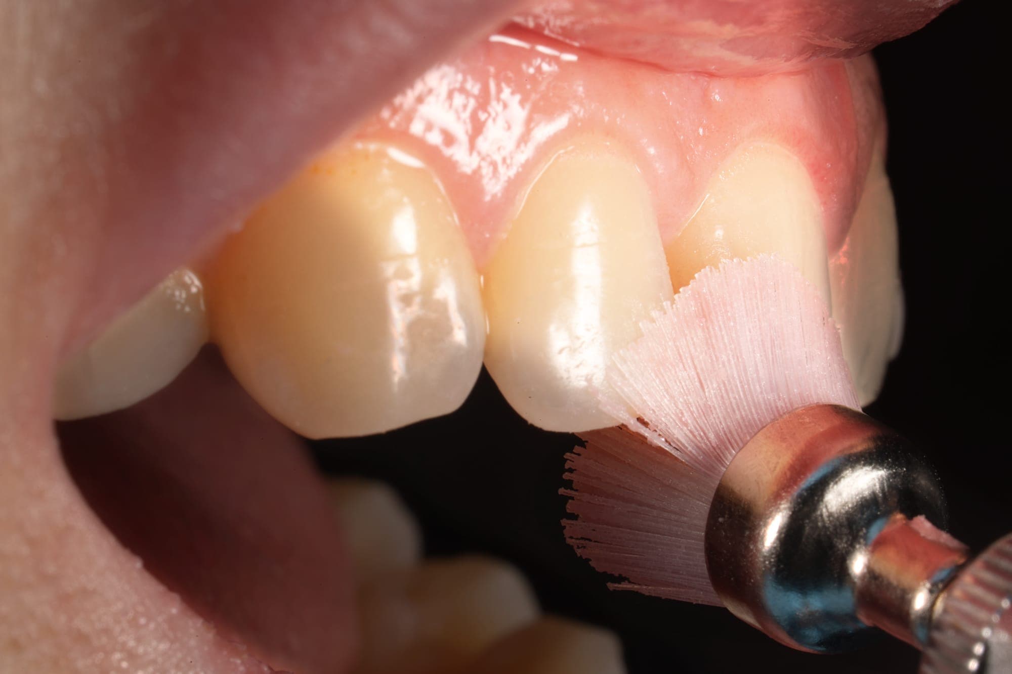 Gleam of Healthy Gingiva